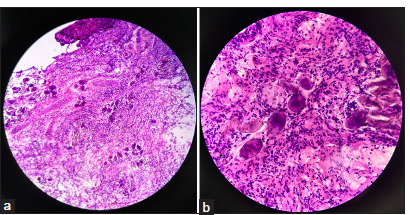 Open Brain Biopsy — Figure 2: