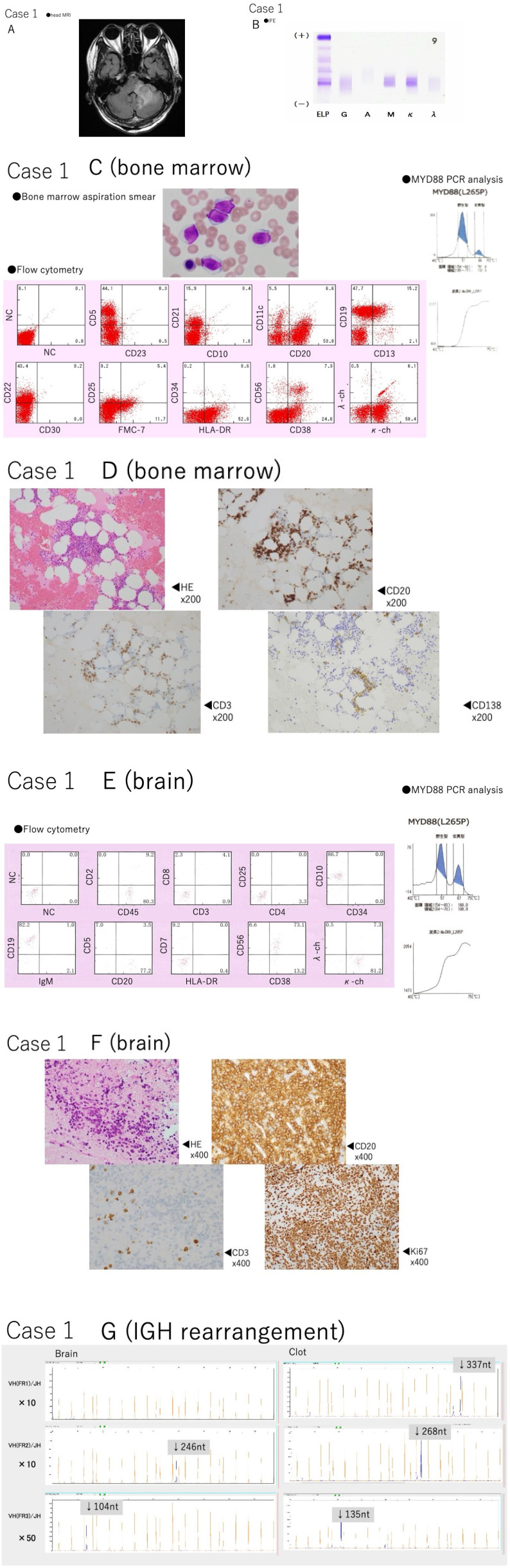 Open Brain Biopsy — Fig. 1