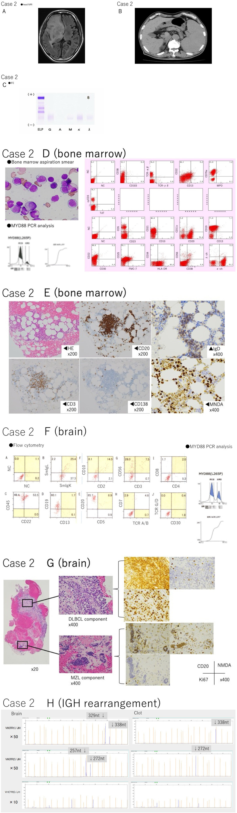 Open Brain Biopsy — Fig. 2