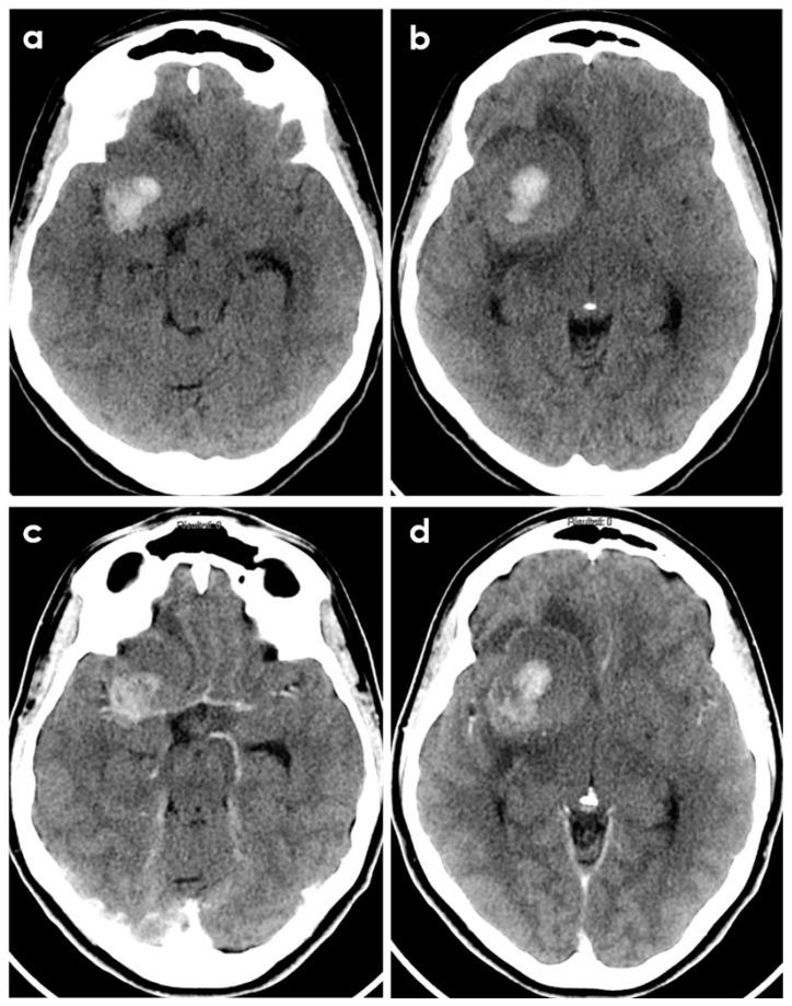 Open Brain Biopsy — Figure 2