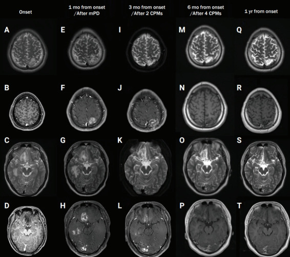 Open Brain Biopsy — Figure 1.