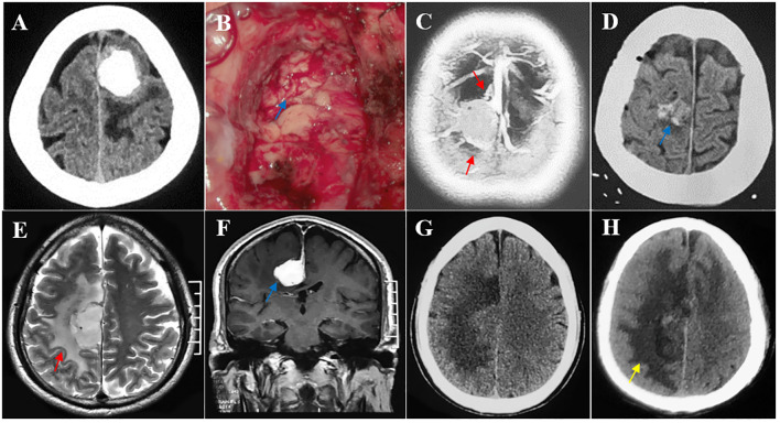 Parasagittal Falx Meningioma Resection — Figure 4