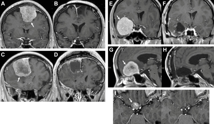Parasagittal Falx Meningioma Resection — Figure 2