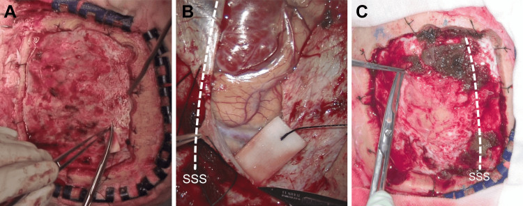 Parasagittal Falx Meningioma Resection — Figure 3