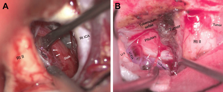 Parasagittal Falx Meningioma Resection — Figure 4