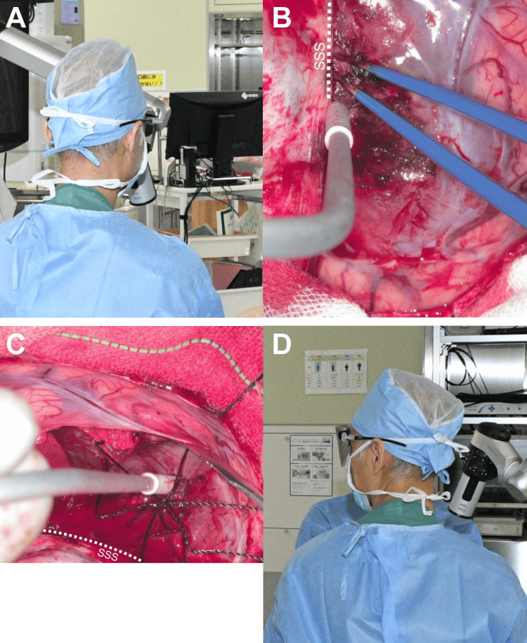 Parasagittal Falx Meningioma Resection — Figure 5