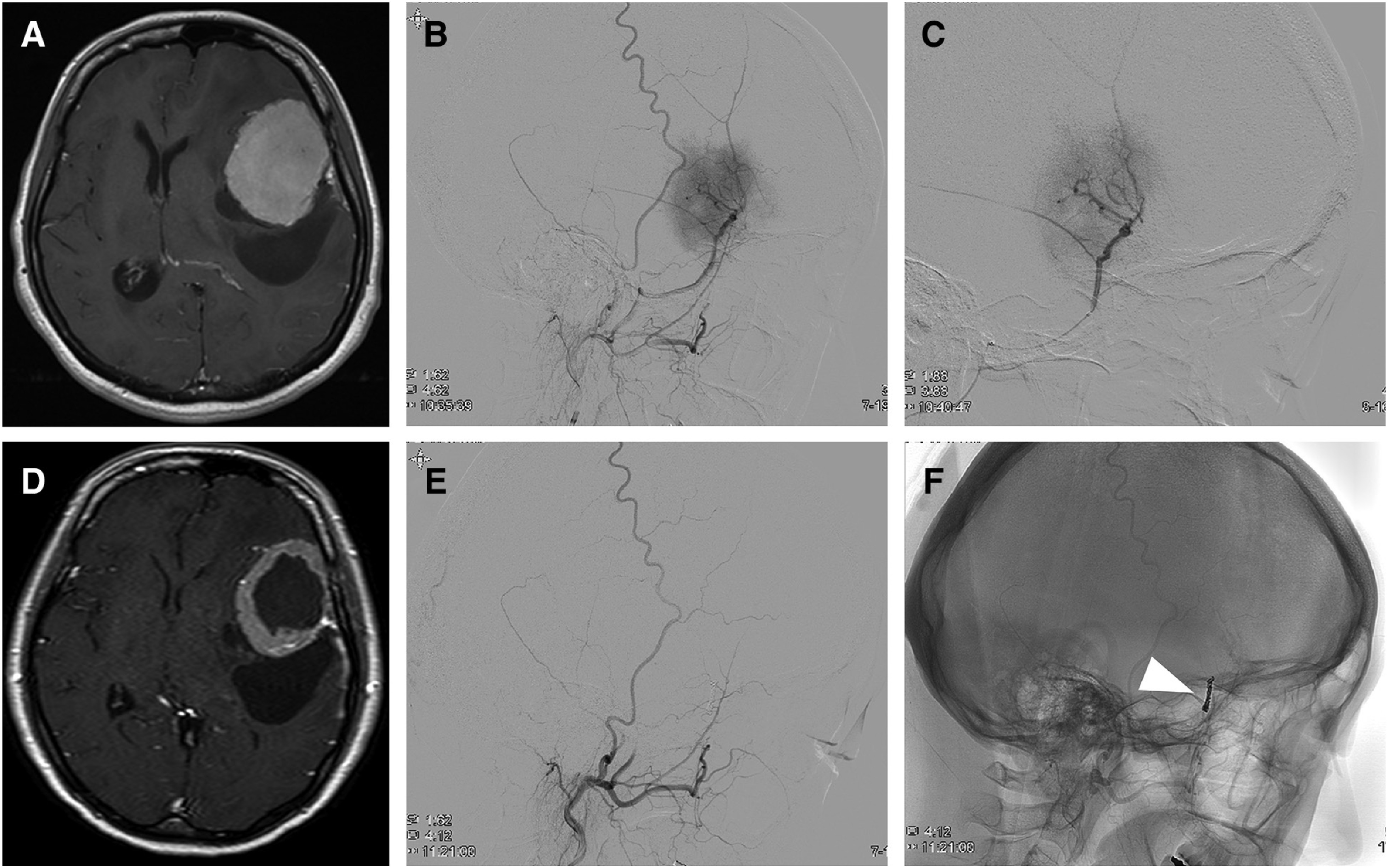 Parasagittal Falx Meningioma Resection — Fig. 1