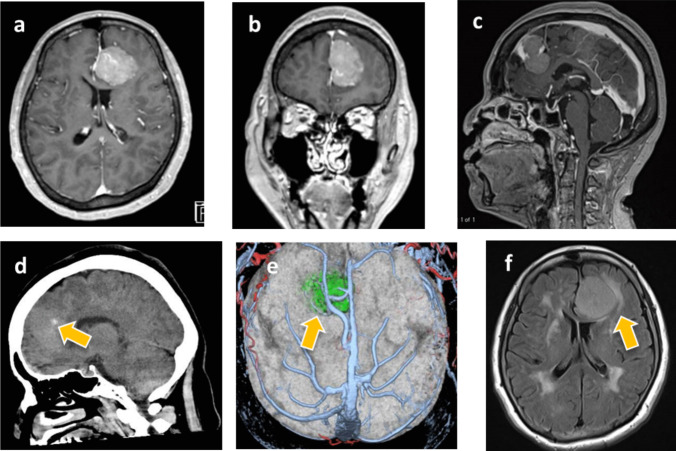 Parasagittal Falx Meningioma Resection — Fig. 1