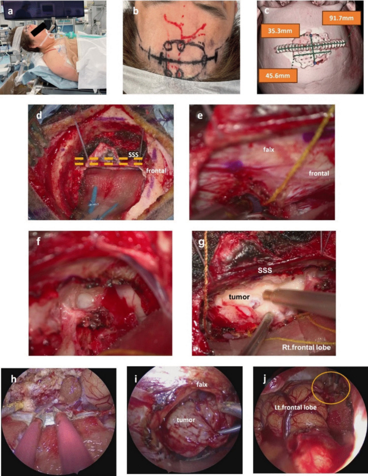 Parasagittal Falx Meningioma Resection — Fig. 2