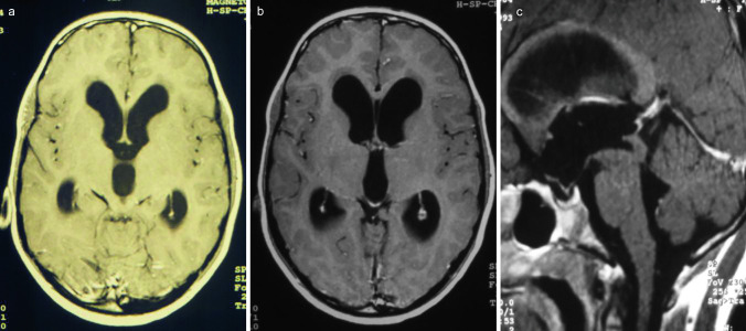 Pediatric Endoscopic Third Ventriculostomy — Fig. 1