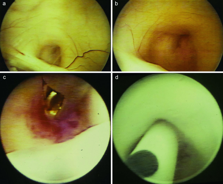 Pediatric Endoscopic Third Ventriculostomy — Fig. 2