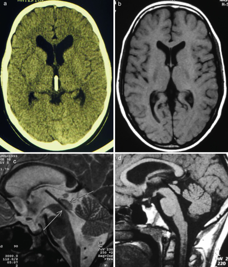 Pediatric Endoscopic Third Ventriculostomy — Fig. 3