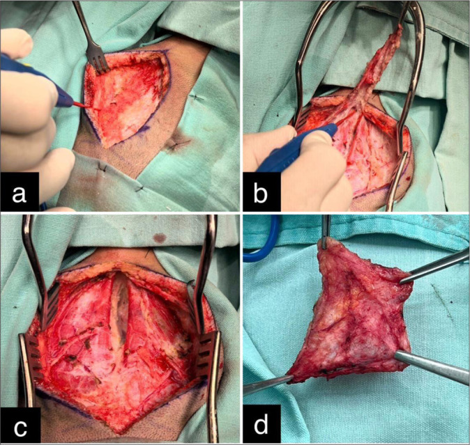 Pediatric Posterior Fossa Tumor Resection — Figure 1: