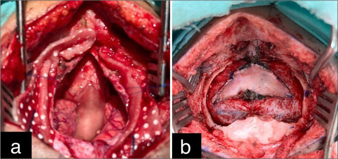 Pediatric Posterior Fossa Tumor Resection — Figure 2: