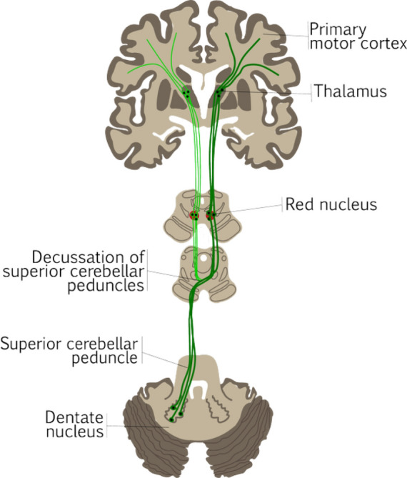 Pediatric Posterior Fossa Tumor Resection — Fig. 1
