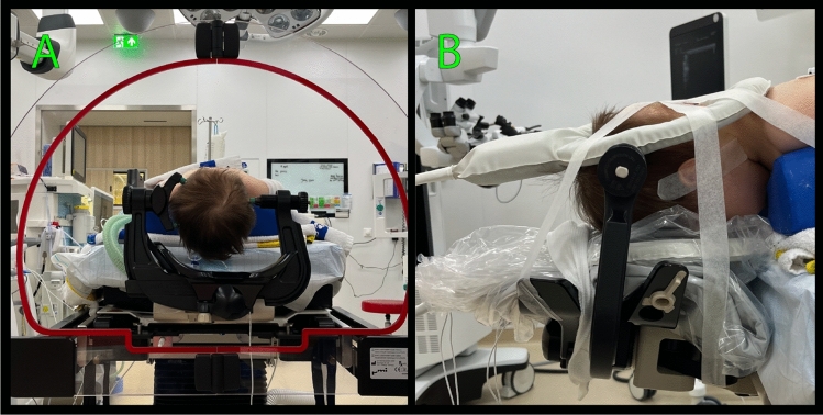 Pediatric Posterior Fossa Tumor Resection — Fig. 2