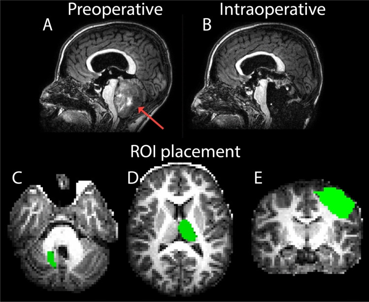 Pediatric Posterior Fossa Tumor Resection — Fig. 3