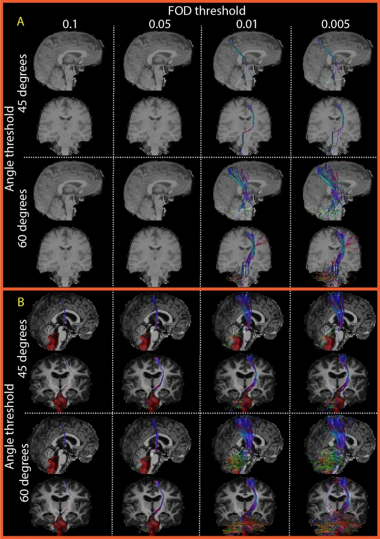 Pediatric Posterior Fossa Tumor Resection — Fig. 4