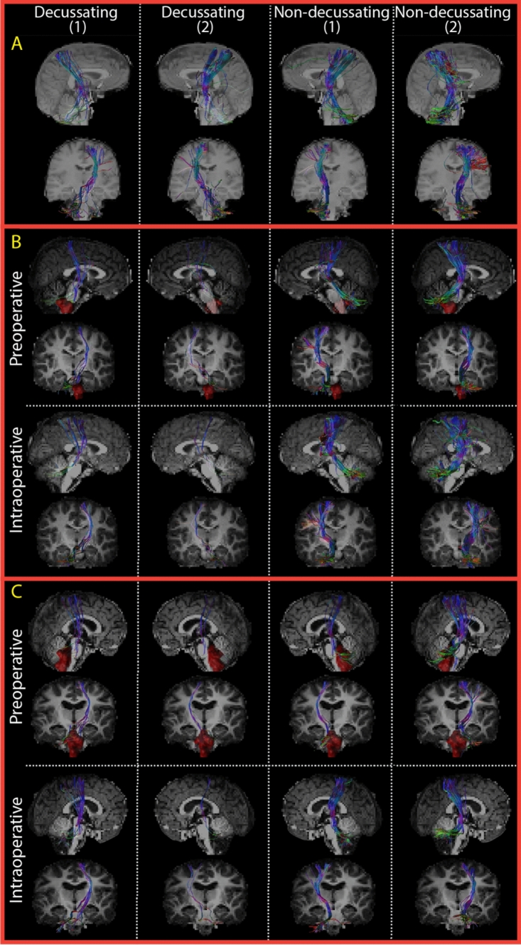 Pediatric Posterior Fossa Tumor Resection — Fig. 6