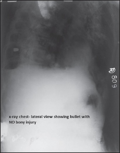 Penetrating Spine Injury Management — Figure 1