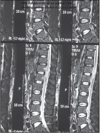 Penetrating Spine Injury Management — Figure 3