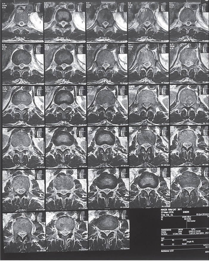 Penetrating Spine Injury Management — Figure 4