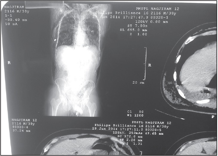 Penetrating Spine Injury Management — Figure 5