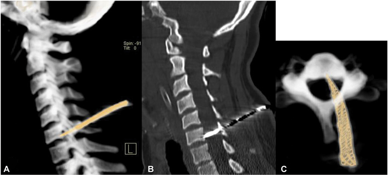 Penetrating Spine Injury Management — Fig. 1