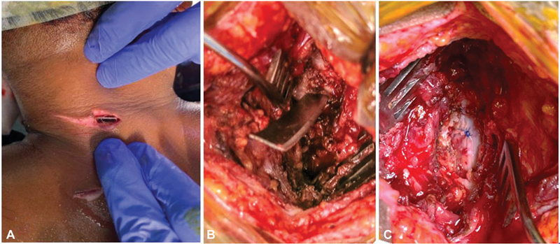 Penetrating Spine Injury Management — Fig. 2