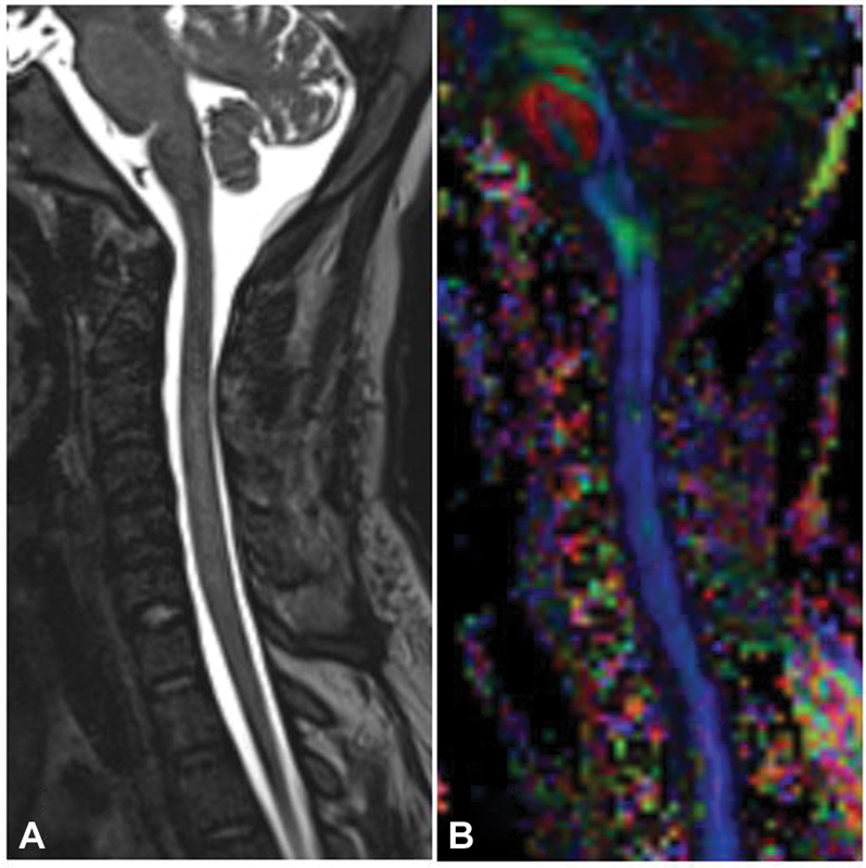 Penetrating Spine Injury Management — Fig. 3