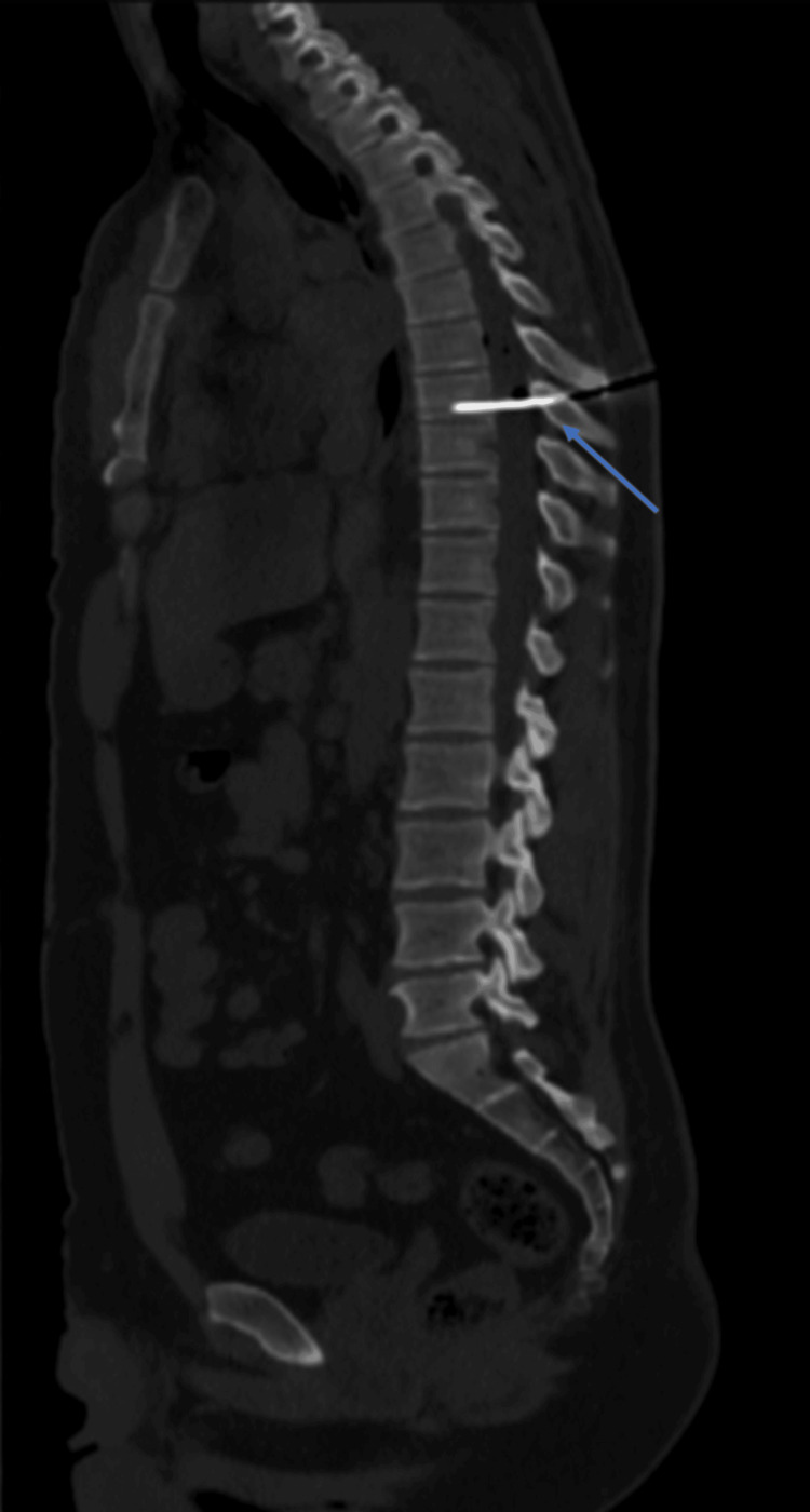 Penetrating Spine Injury Management — Figure 1