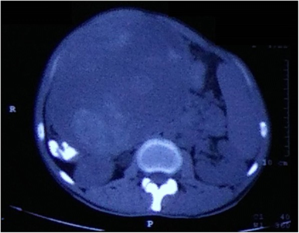 Peripheral Nerve Sheath Tumor Resection — Fig. 1
