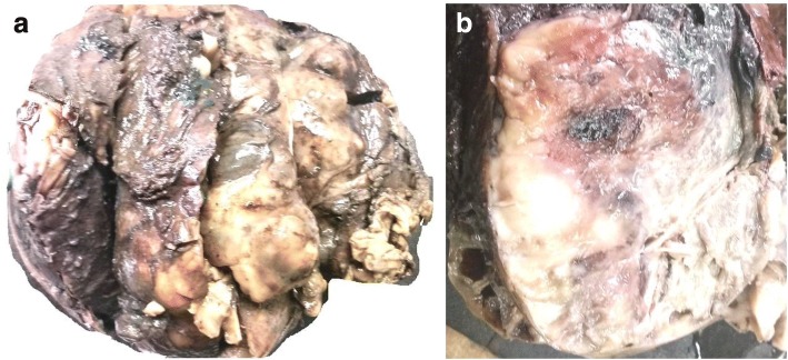Peripheral Nerve Sheath Tumor Resection — Fig. 2