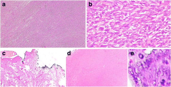 Peripheral Nerve Sheath Tumor Resection — Fig. 3