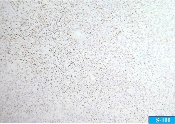 Peripheral Nerve Sheath Tumor Resection — Fig. 4