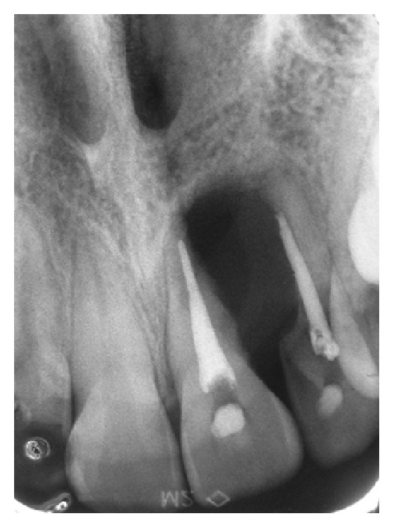 Peripheral Nerve Sheath Tumor Resection — Figure 1