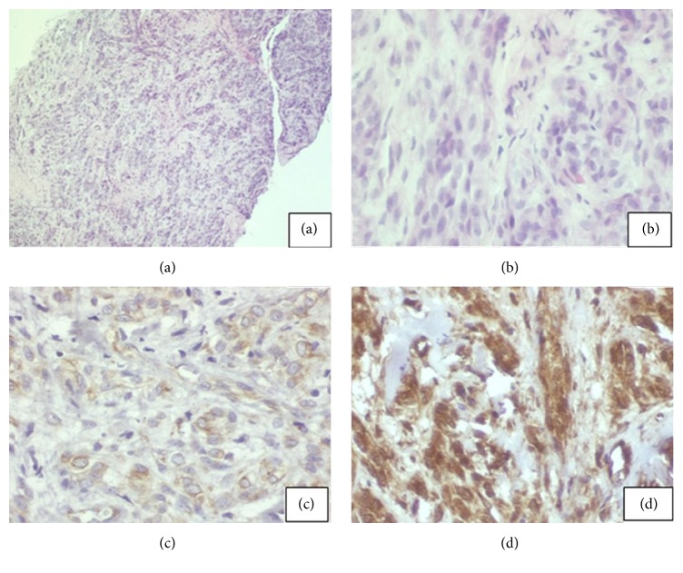 Peripheral Nerve Sheath Tumor Resection — Figure 2