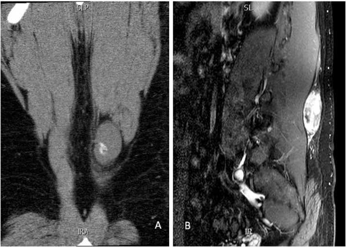 Peripheral Nerve Sheath Tumor Resection — Fig. 1