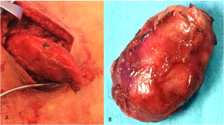 Peripheral Nerve Sheath Tumor Resection — Fig. 2