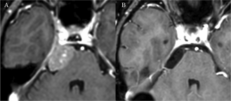Petroclival Meningioma Resection — Fig. 1