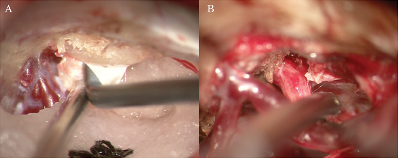 Petroclival Meningioma Resection — Fig. 2