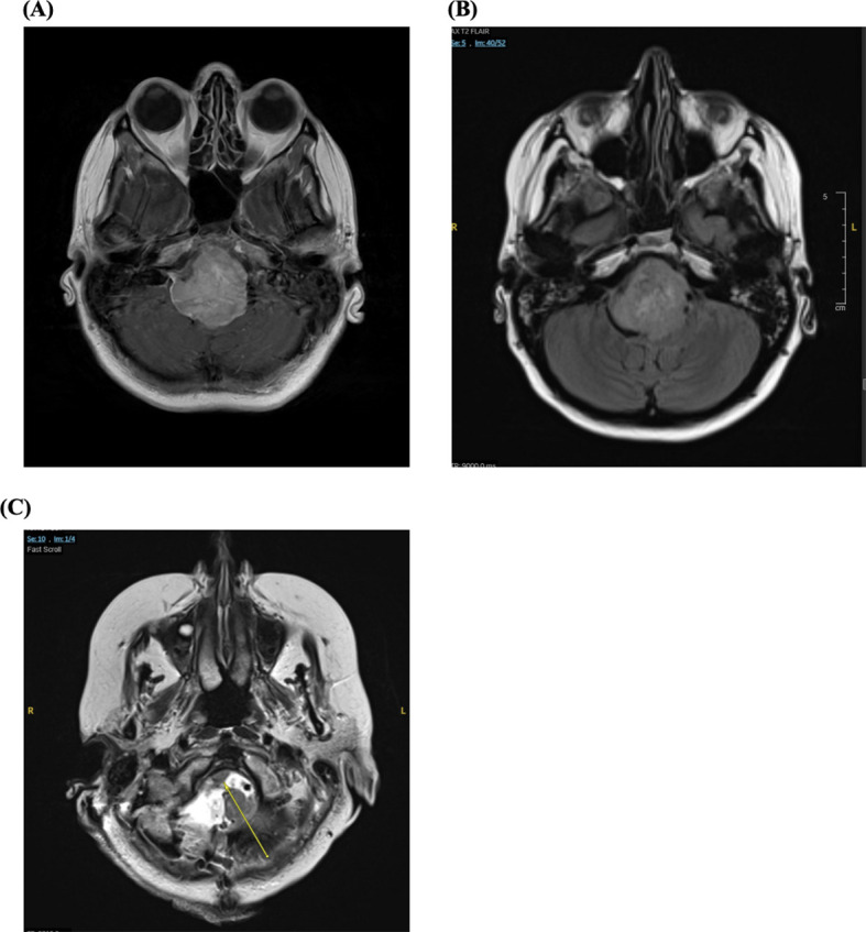 Petroclival Meningioma Resection — Figure 1