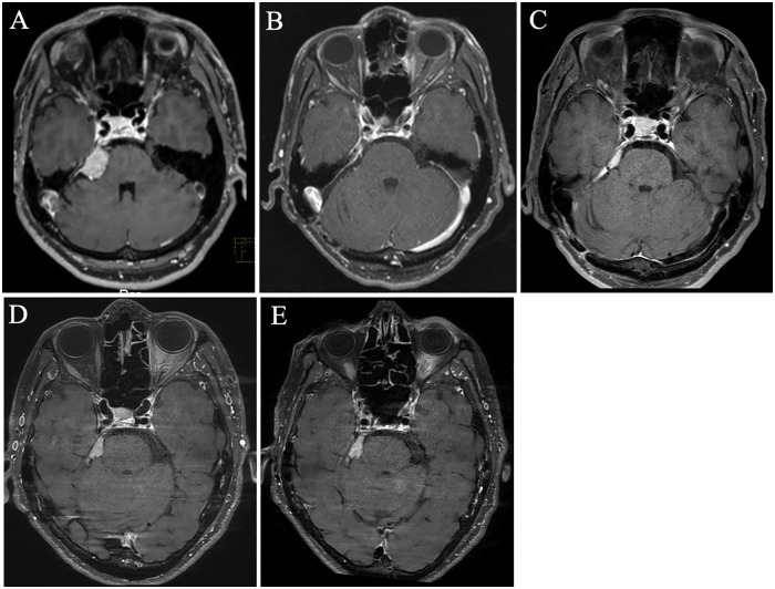 Petroclival Meningioma Resection — Figure 1