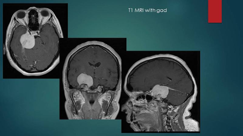 Petroclival Meningioma Resection — Fig. 1