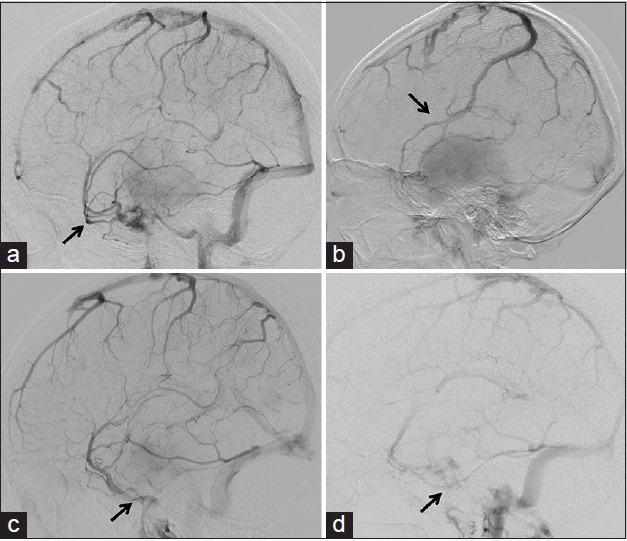 Petroclival Meningioma Resection — Figure 1