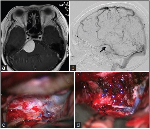 Petroclival Meningioma Resection — Figure 2
