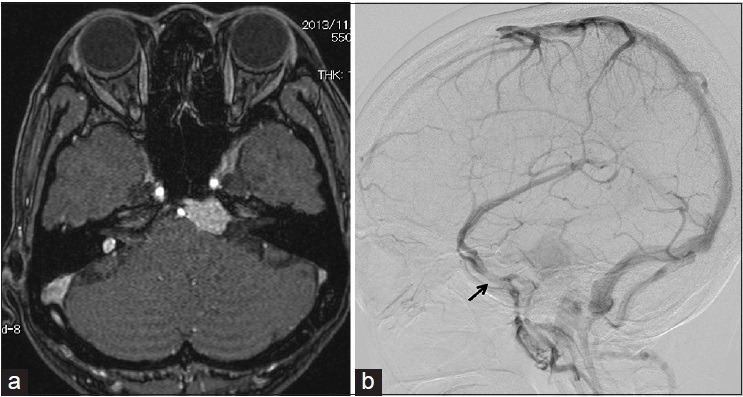 Petroclival Meningioma Resection — Figure 3
