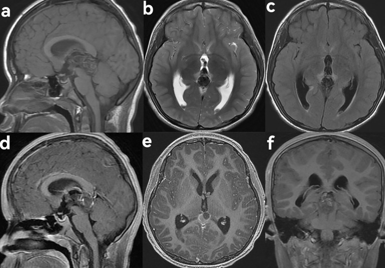 Pineal Region Tumor Resection — Figure 2