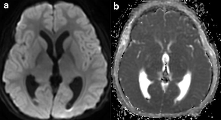 Pineal Region Tumor Resection — Figure 3