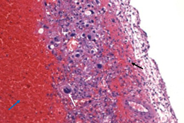 Pineal Region Tumor Resection — Figure 4